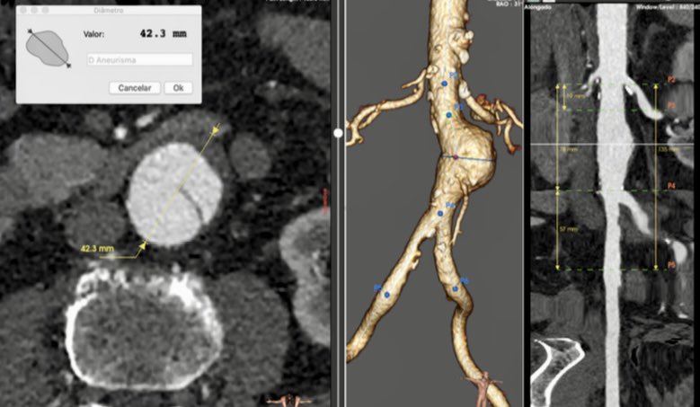 Marcus Vinicius Borges MD ★ 彡 🇧🇷 (@mvborges) on Twitter photo Dissecting AAA or AAA with dissection?
<a href="/farkomd/">frank arko</a>
<a href="/raimcsantos/">Raimundo C. Santos, MD.</a>
<a href="/VascularForum/">Fórum Vascular</a>
#AortaEd Dissecting AAA or AAA with dissection?
<a href="/farkomd/">frank arko</a>
<a href="/raimcsantos/">Raimundo C. Santos, MD.</a>
<a href="/VascularForum/">Fórum Vascular</a>
#AortaEd
