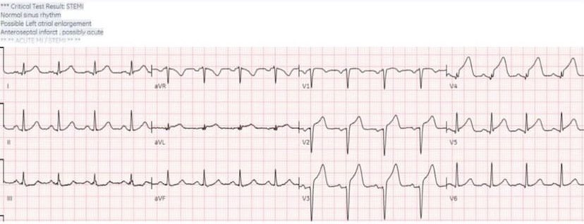40 year old with 10 days on/off chest pain, and Q waves. Is this a completed infarct? 
#ECG #EKG #FOAMed #MedEd #medstudent #resident #nurse #CardioTwitter #paramedic #EmergencyMedicine