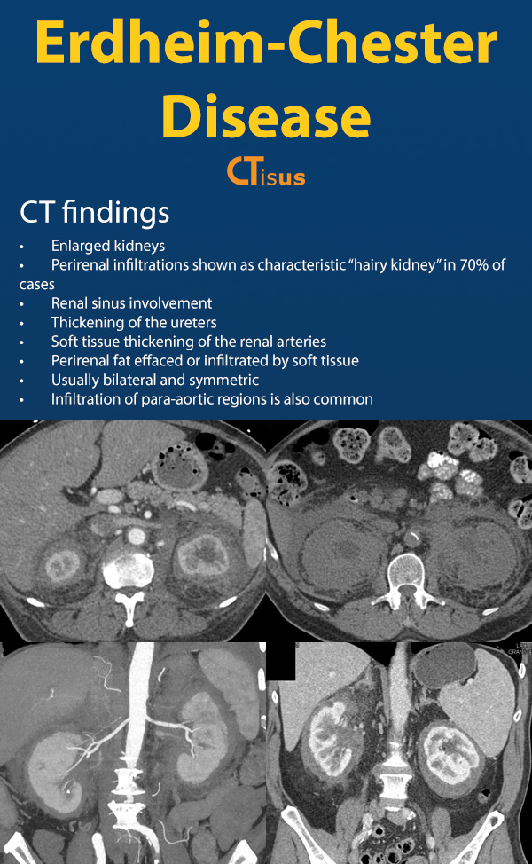 Erdheim-Chester Disease: CT Findings

ctisus.com/learning/featu…