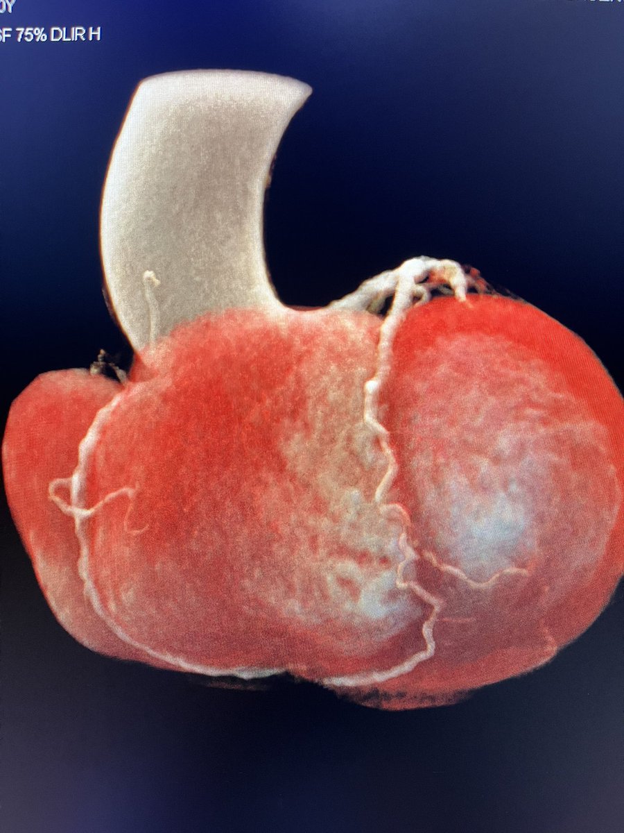 Circulación colateral de la DA a la DP. La DP con oclusión proximal. #YeSCCT #CCTA @Heart_SCCT @EACVIPresident @escardio @ACCinTouch @SISIACOficial