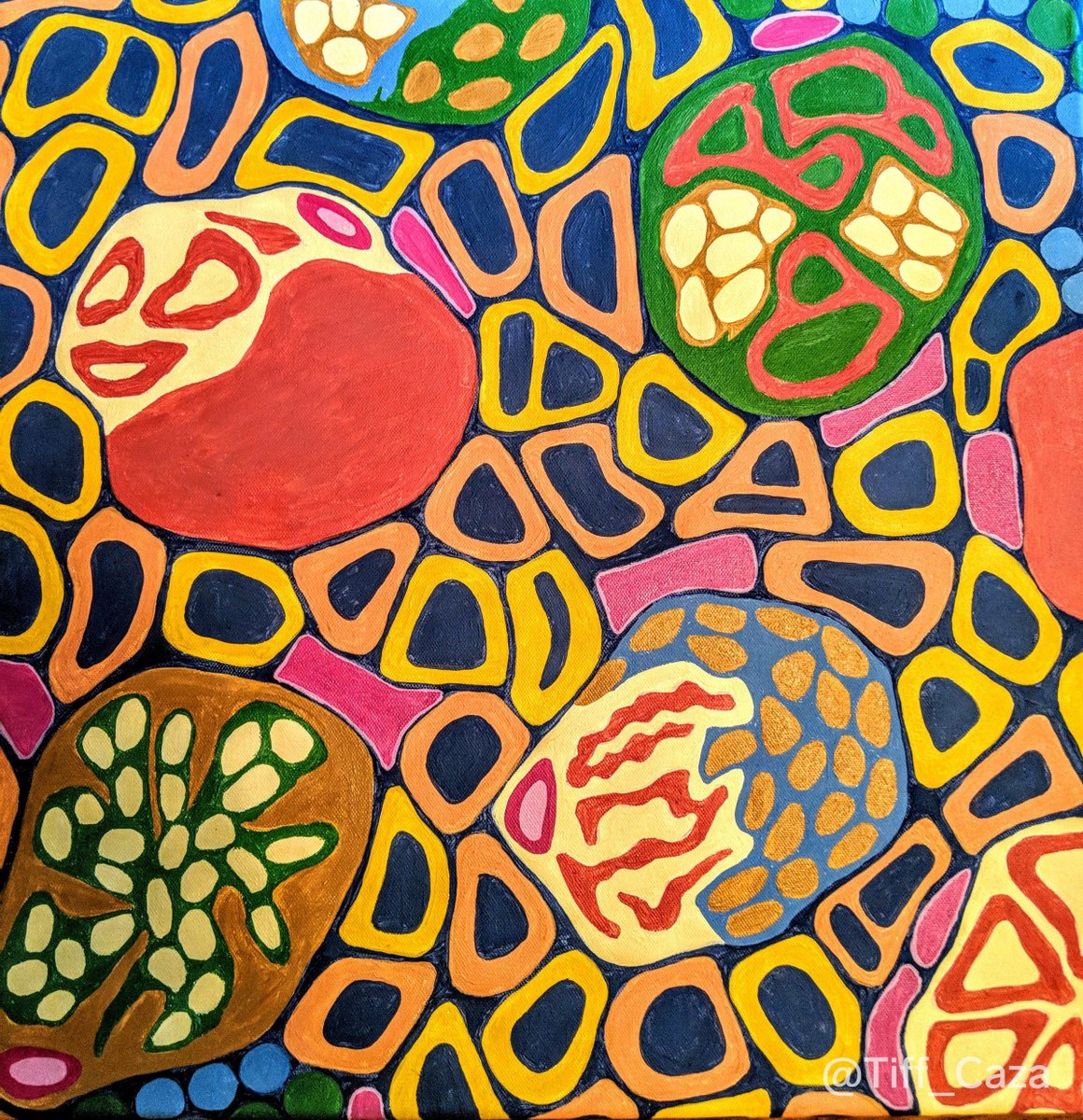 In honor of #IgANDay, we wanted to share this painting by @Tiff_Caza. It shows glomeruli with mesangial hypercellularity, endocapillary hypercellularity, and crescent formation. These findings can be seen in IgA nephropathy, and other active glomerulonephritides. These