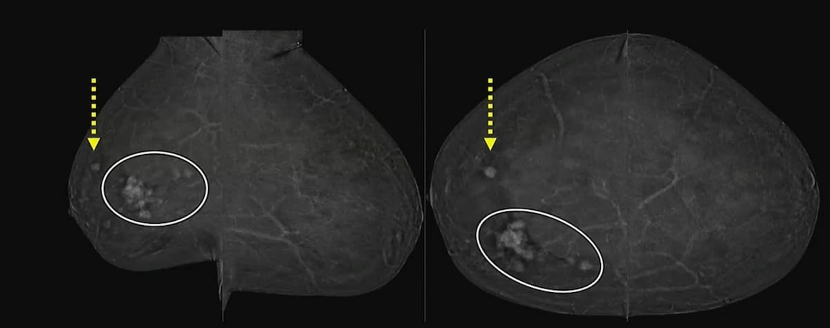 Current Insights and Emerging Roles for Contrast-Enhanced #Mammography diagnosticimaging.com/view/current-i… @ACRRFS @ACRYPS @RadiologyACR @ARRS_Radiology @RSNA @BreastImaging @SBIRFS @RadiologyUSC @UWRadiology @UofURadiology @MayoRadiology @UNMRadiology @RadiologyUcla #radiology #RadRes