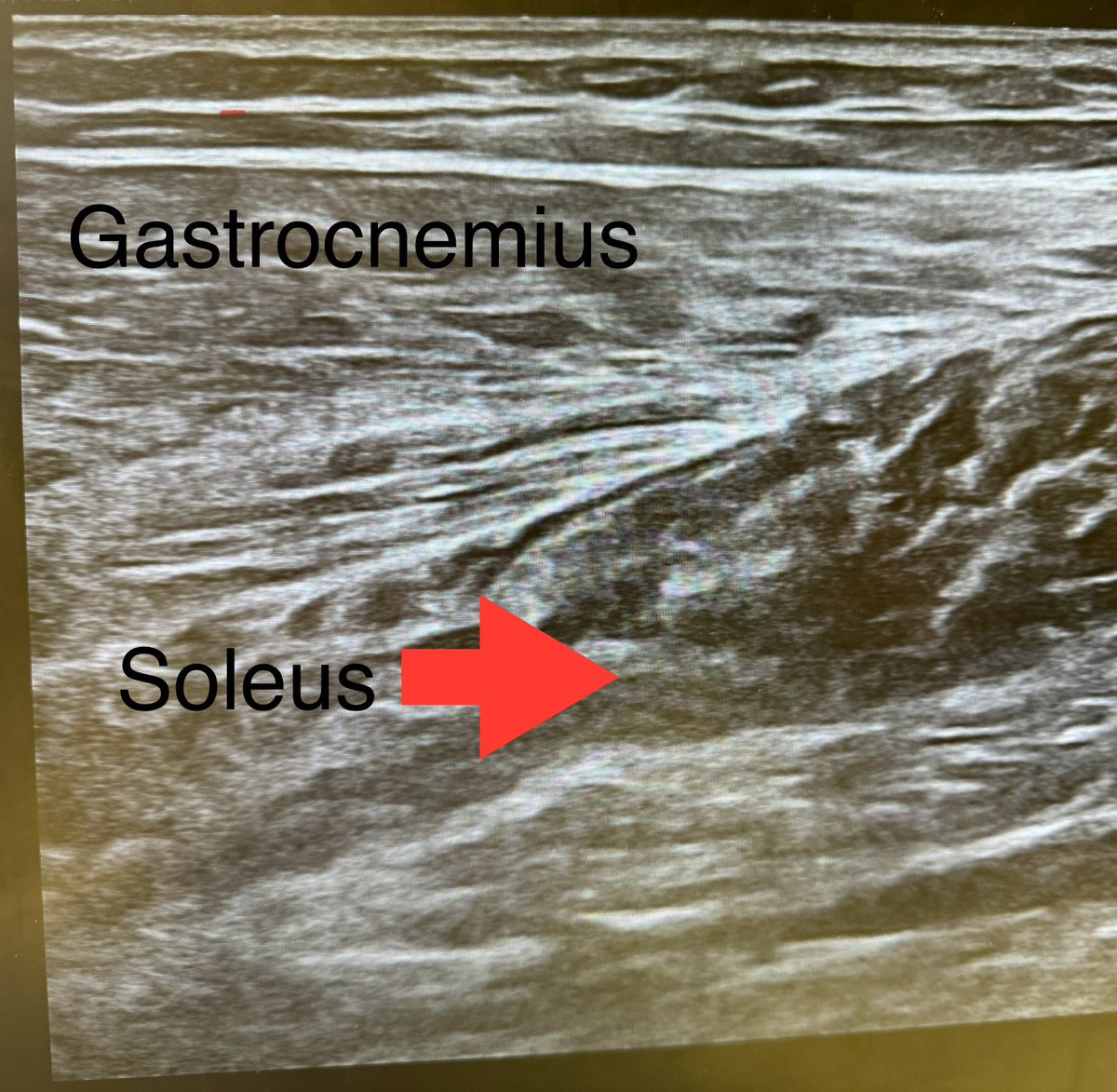 Here’s what a grade 1 (mild) soleus (calf) strain looks like on ultrasound. This is what Bucks Giannis and Celtics Porzingis have been dealing with.
