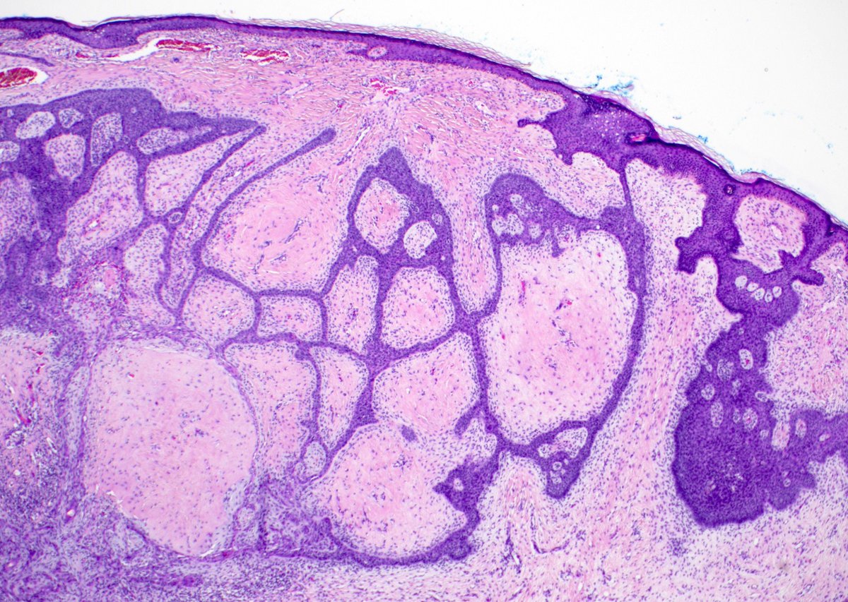 Skin lesion on lower back of adult. Diagnosis? 
Answer: youtube.com/watch?v=drX67H… 
#pathology #pathologists #pathTwitter #dermpath #dermatology #dermatologia #dermtwitter