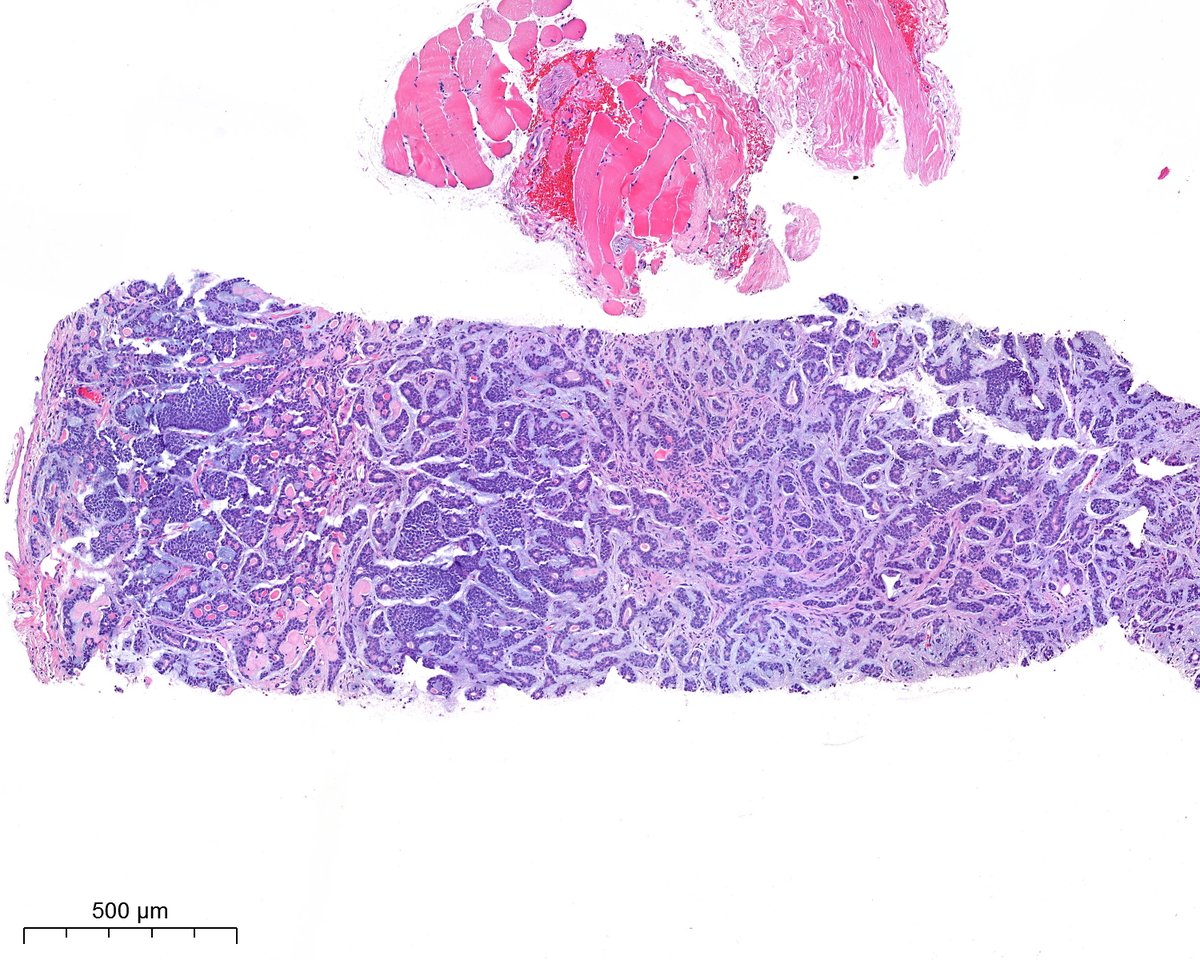 PoloniaAntonio's tweet image. Beauty is in the eyes of the beholder. F, 60s, lung! #lungpath @atman_ci @smlungpathguy @DrGeeONE @tlabiano @A_Morini_MD @ariella8 @surgpathlahore @DrNishatAfroz2 @amalasar86 @gonzadetoro @TristanRutland7 @LoboAnandi @SumantaDas_7 @israhkhan @kis_lorand @pepeheffernan