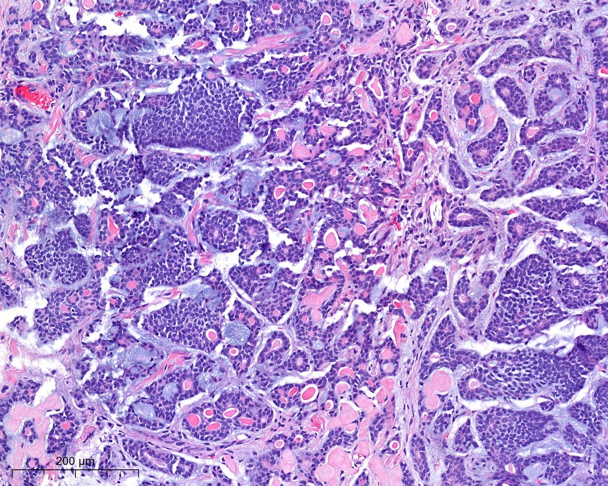 PoloniaAntonio's tweet image. Beauty is in the eyes of the beholder. F, 60s, lung! #lungpath @atman_ci @smlungpathguy @DrGeeONE @tlabiano @A_Morini_MD @ariella8 @surgpathlahore @DrNishatAfroz2 @amalasar86 @gonzadetoro @TristanRutland7 @LoboAnandi @SumantaDas_7 @israhkhan @kis_lorand @pepeheffernan