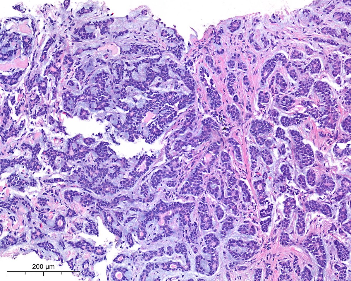 Beauty is in the eyes of the beholder. F, 60s, lung! #lungpath @atman_ci @smlungpathguy @DrGeeONE @tlabiano @A_Morini_MD @ariella8 @surgpathlahore @DrNishatAfroz2 @amalasar86 @gonzadetoro @TristanRutland7 @LoboAnandi @SumantaDas_7 @israhkhan @kis_lorand @pepeheffernan