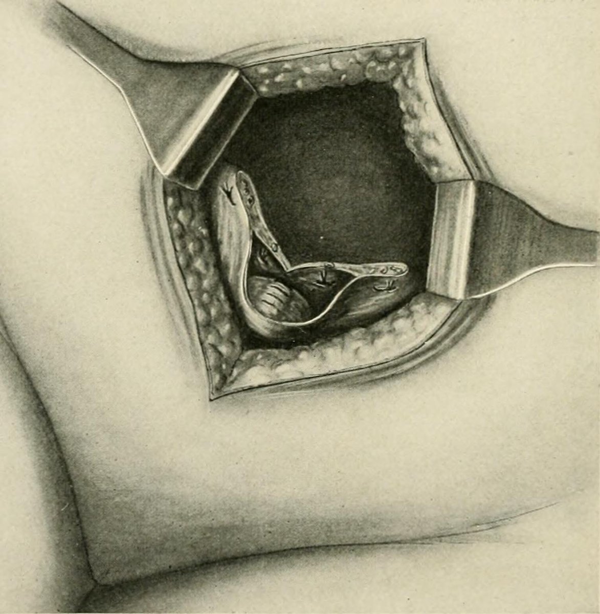 1910 medical illustration showing sutures in the cervical stump following an abdominal hysterectomy. The text recommends suturing the stump to remaining ligaments to provide support to the pelvic floor and prevent prolapse.