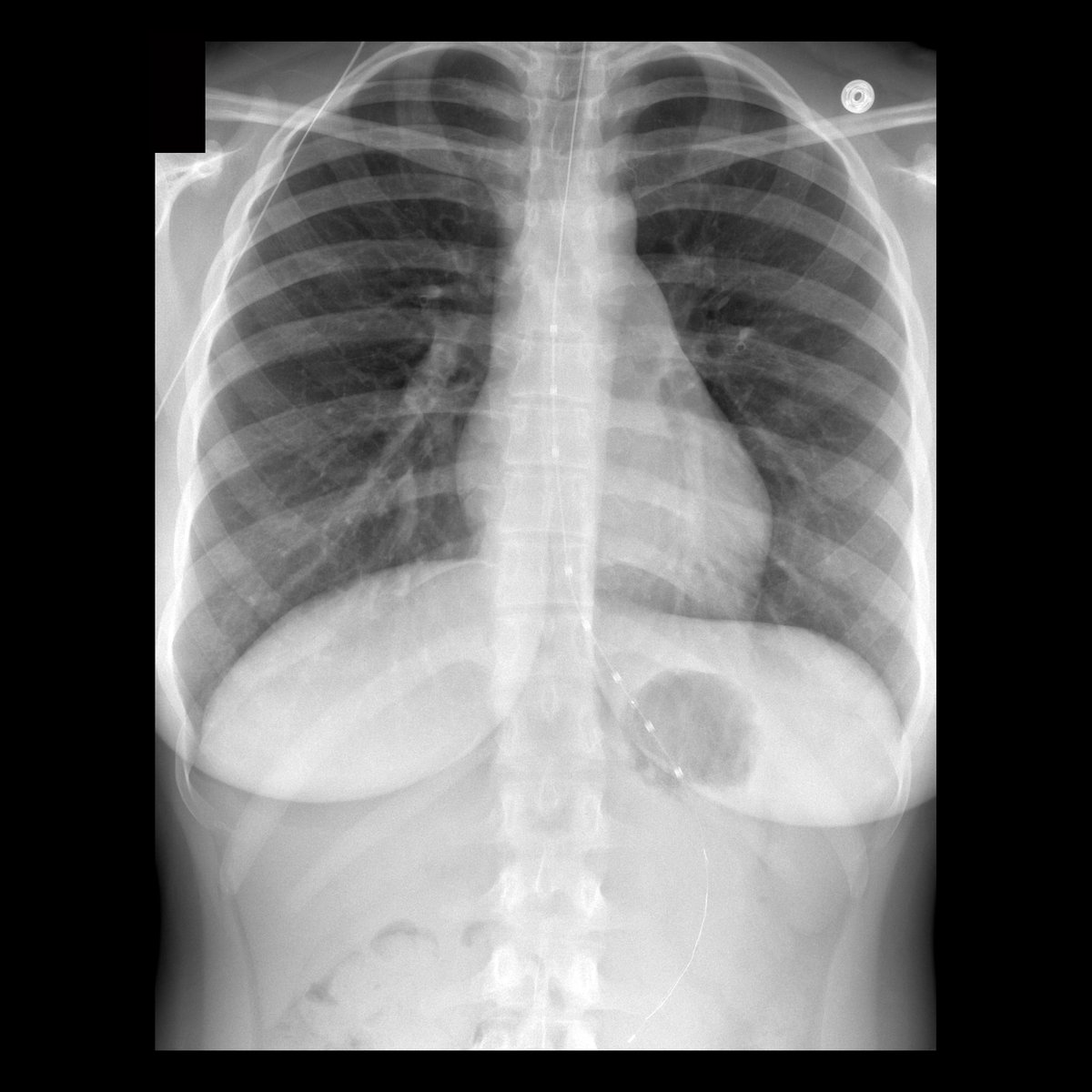 Teen with heartburn

CXR shows an esophageal pH probe. Position of esophageal pH probe sensor/measurement lead (the radiolucent cylinder with radiopaque dot in center of it) is at gastroesophageal junction. 

#FOAMed #MedEd #FOAMPed #FOAMRad #PedsRad #RadEd #RadRes #radiology