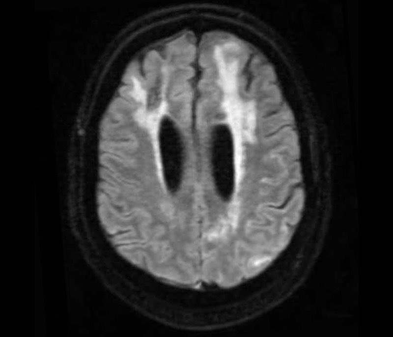 Weill Cornell Neurology (@wcmcneurology) on Twitter photo Congratulations to our Dr. Samuel Bruce for launching a novel study to better understand cerebral amyloid angiopathy (CAA) & CAA-related inflammation (CAA-ri)
<a href="/WeillCornell/">Weill Cornell Medicine</a> <a href="/nyphospital/">NewYork-Presbyterian</a>
nyp.org/advances/artic… Congratulations to our Dr. Samuel Bruce for launching a novel study to better understand cerebral amyloid angiopathy (CAA) & CAA-related inflammation (CAA-ri)
<a href="/WeillCornell/">Weill Cornell Medicine</a> <a href="/nyphospital/">NewYork-Presbyterian</a>
nyp.org/advances/artic…