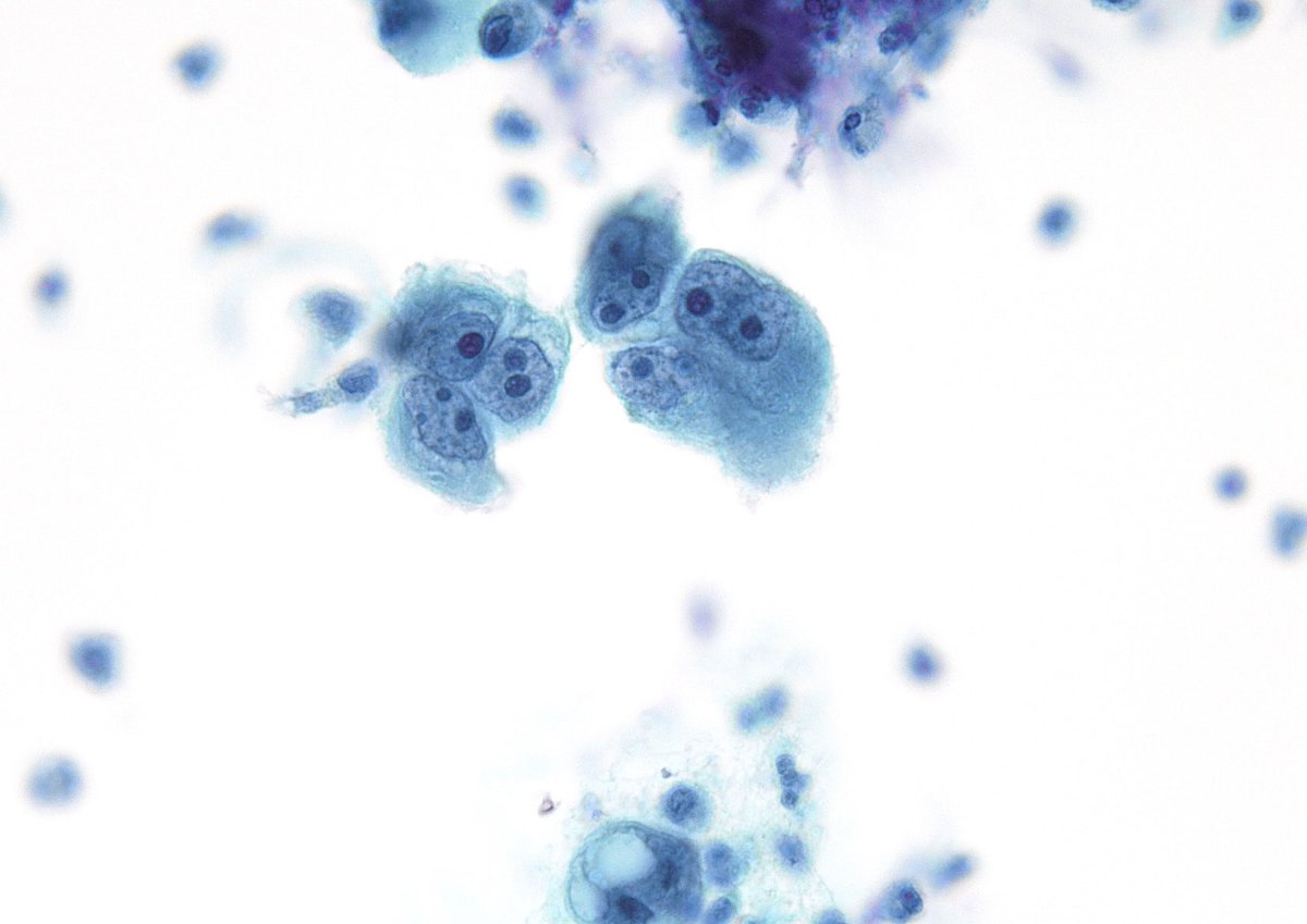 SOLITARY macronucleoli are typically a bad finding n Cytopathology particularly in a Gyn PAP test - shown here are exfoliated cells from a uterine MMMT. (SurePath)