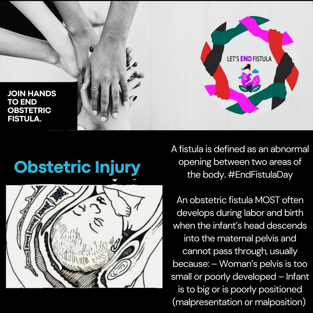 The marking of the International Day to End Obstetric Fistula is fast approaching. 
Here is short description of this child birth injury that has devastated many women's lives. 

We can #EndFistula in our generation. 

Learn more about our work here: letsendfistula.org.