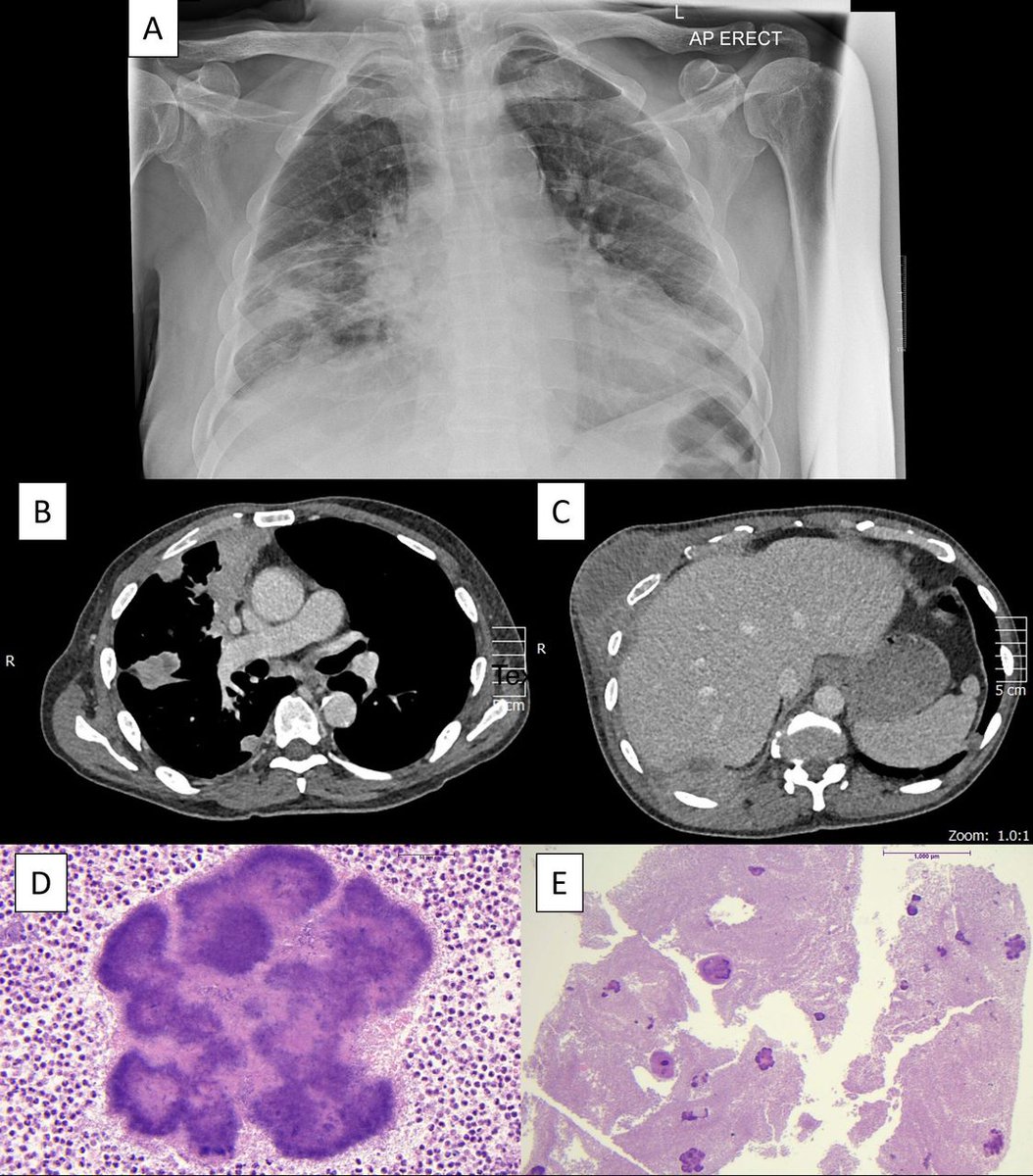 Actinomycosis mimicking metastatic lung malignancy thorax.bmj.com/content/early/…