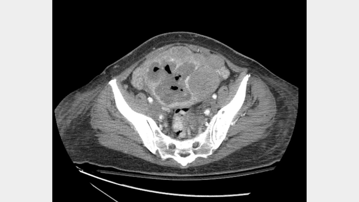 🩻 Case Study of the Week! Post your guess in the comments and check back on Friday to see if your diagnosis was correct! See all the case details, more images, and diagnosis ➡️ bit.ly/4bje2oU #RadEd #Radiology #CaseOfTheWeek #RadRes #CaseStudy #NWHW #COW #Mammo