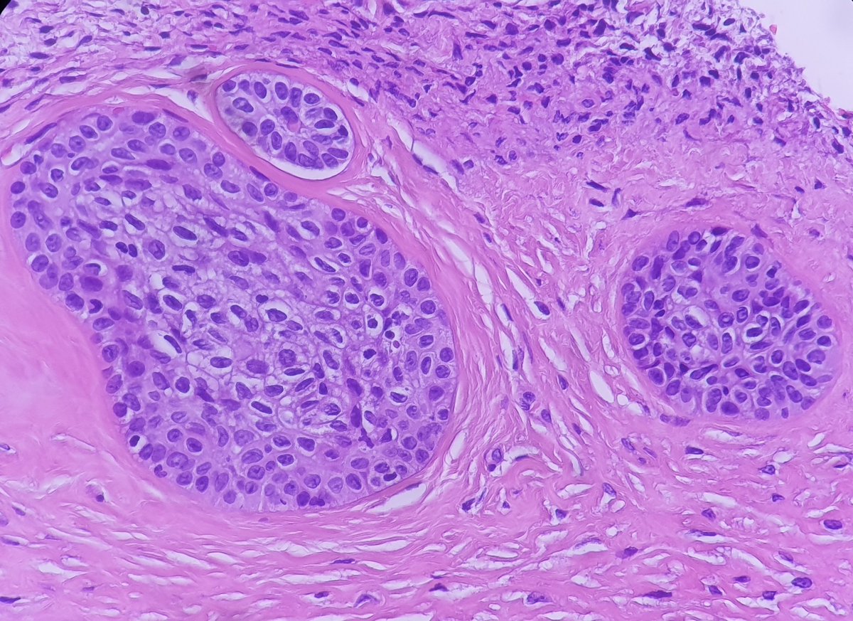 Dear #pathtwitter #GYNpath, need your opinion, 23 yo with bilateral ovarian mature cystic teratoma - found a 4 mm small nest of transitional epithelium. Will you describe it as a walthard cell nest, metaplastic changes, or small nodule concerning for Brenner tumor. Thank you