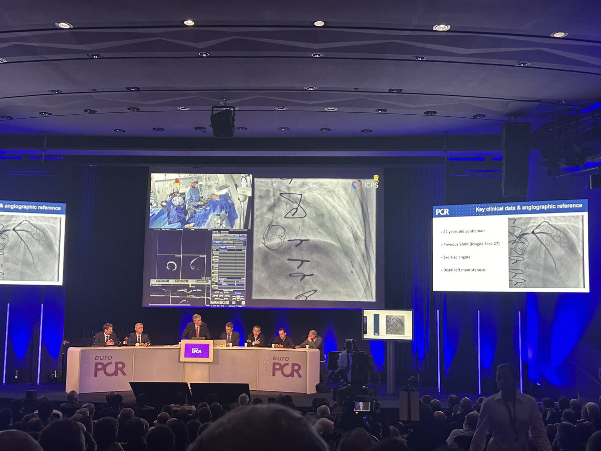 ICPS is proud to be present at EuroPCR  through conferences and interventions.
You can now find Dr <a href="/DrGarot/">Dr Philippe Garot</a> as discussant, <a href="/DrThomasHovasse/">Dr Thomas Hovasse</a> @HakimBenamer as operators this afternoon for a left main and complex bifurcation stenting in live at ICPS
#EuroPCR2024 #CardioTwitter