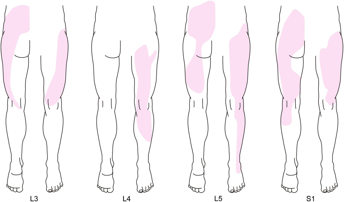 Musculoskeletal mimics of lumbosacral radiculopathy 👉 Patterns of referred pain from lumbosacral interspinous ligaments according to Kellgren et al. cir.nii.ac.jp/crid/157029122… pubmed.ncbi.nlm.nih.gov/38726566/