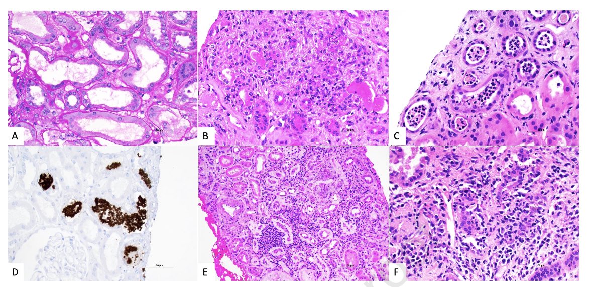 Características clínicas e histológicas de 112 personas que tuvieron biopsias renales y consumían metanfetaminas: •creatinina 5.1 mg/dL •proteinuria 65% •hematuria 27% •necrosis tubular aguda ~70% •GMN focal y segmentaría ~50% Kidney Int Rep 2024 doi.org/10.1016/j.ekir….