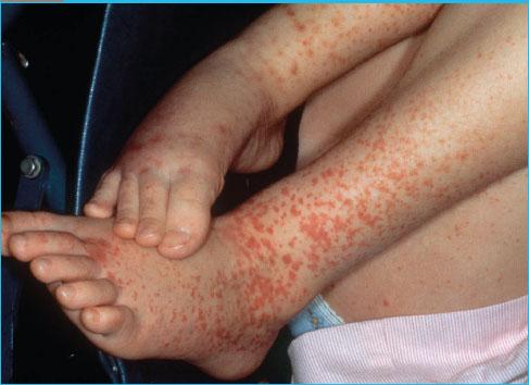 🟣𝘾𝙇𝙄𝙉𝙄𝘾𝘼𝙇 𝙎𝘾𝙀𝙉𝙀𝙍𝙄𝙊:

A child having diarrhoea later complicated by appearance of rash and petechiae. The most probable #diagnosis is:

A.  Campylobacter 
B.  Shigella 
C.  Yersinia 
D.  Rota virus

#medx
#medEd
#MedTwitter