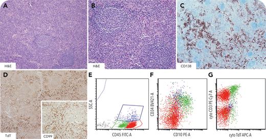 Castleman disease with modest T-lymphoblastic proliferation ow.ly/sx0350RARSg #bloodwork #lymphoidneoplasia