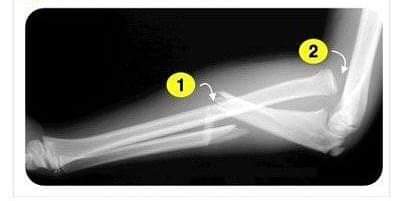 Monteggia fracture Dislocation ⤴️🍃✅
1-Proximal to mid ulna Fracture 
2-Radial head dislocation