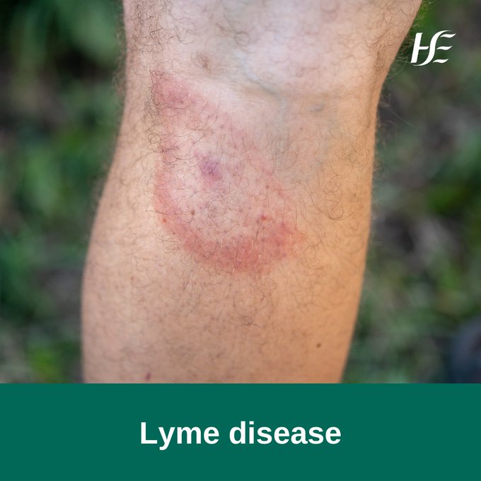 #LymeDisease is a bacterial infection that can be spread to humans by infected ticks. Most people with early symptoms of Lyme disease develop a circular red skin rash around a tick bite. For more information on symptoms to look out for, visit: bit.ly/4dGrWmI
