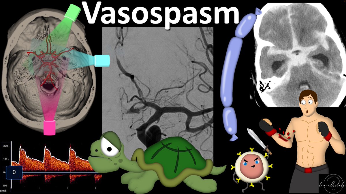 1/Got the diagnosis when it comes to vessel stenosis?

Or is your knowledge narrow when it comes to vessel narrowing?

When it comes to vasospasm, do you know why it happens or what to look for?

Here is the thread you NEED to unravel why vessels twist up!
