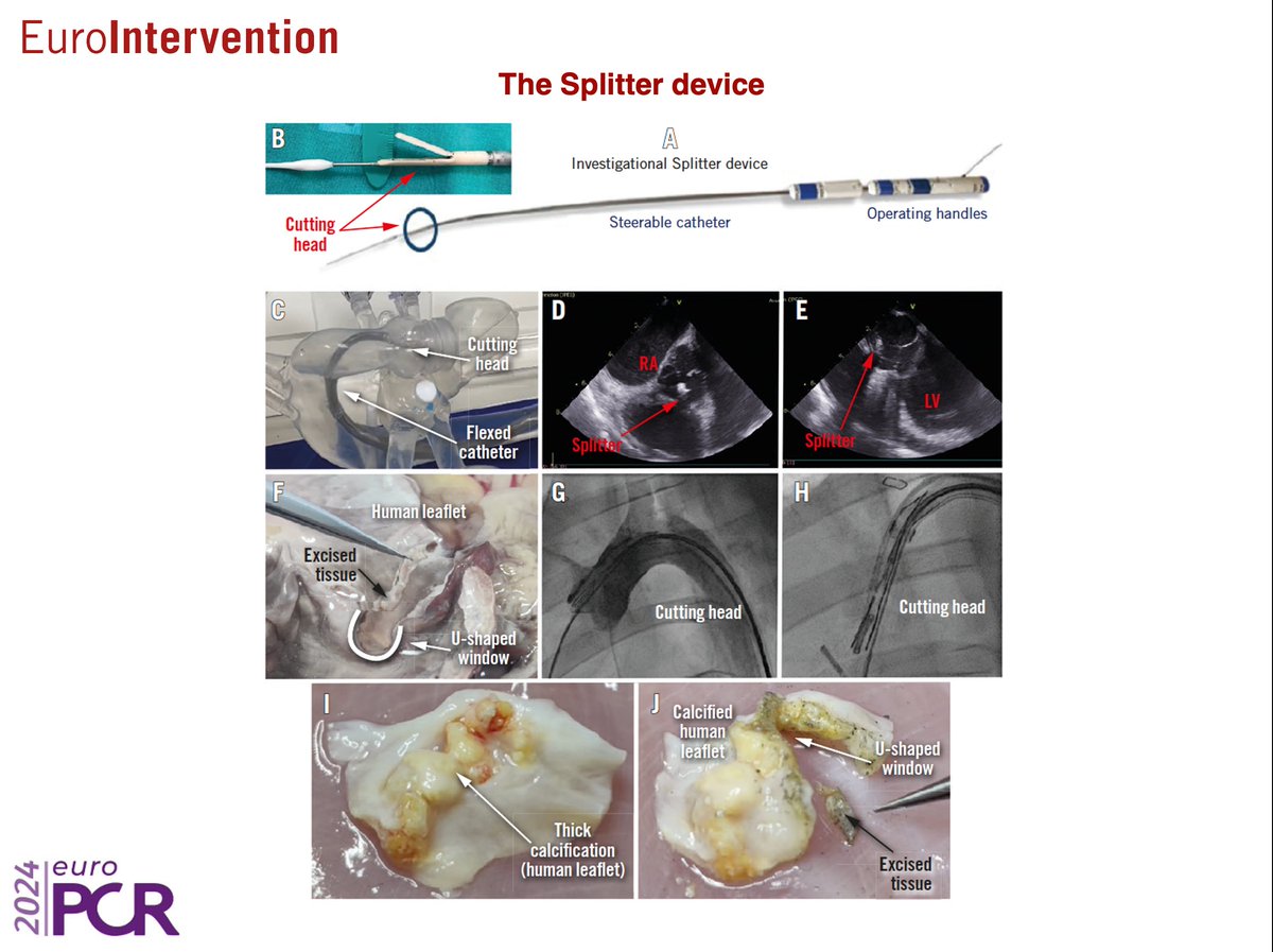 #EuroPCR INNOVATOR'S DAY 'Splitter - a novel device for leaflet modification in transcatheter aortic valve-in-valve implantation procedures.' ow.ly/C07I50RFHsV