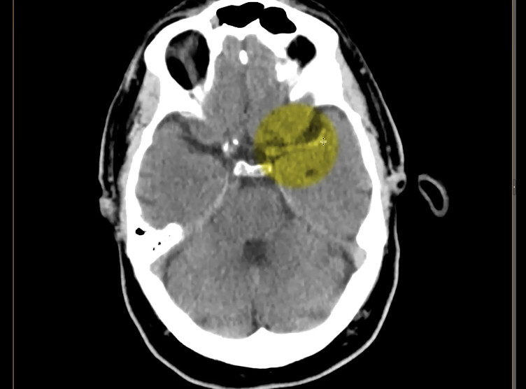 Is this stroke patient a candidate for thrombolysis? History: Patient presents with acute right-sided weakness and aphasia View the case: bit.ly/4b6wukx #radiology #foamed