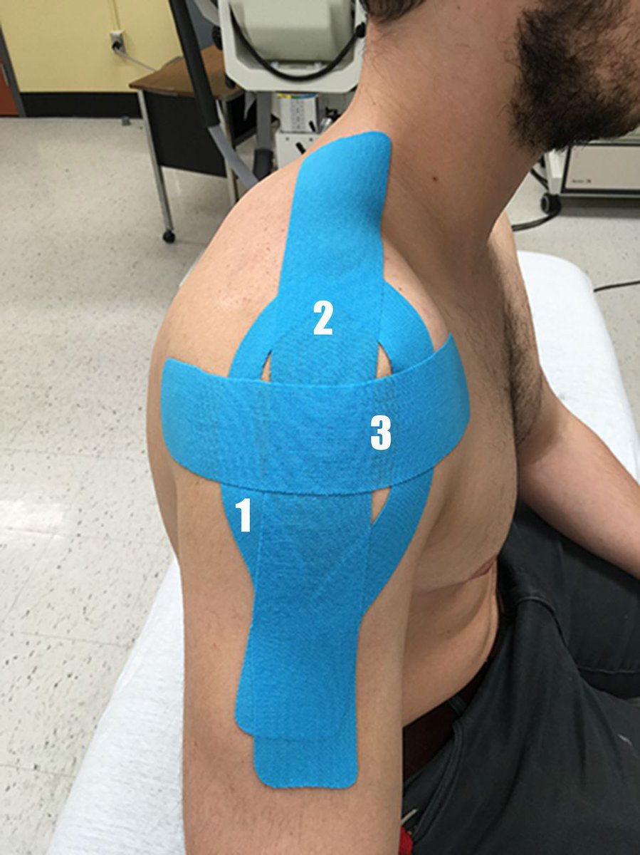 🚨 Can kinesiotaping optimise the results of an exercise-based treatment for rotator cuff-related shoulder pain? 🤷‍♂️ NEW #PhDAcademyAward highlights the key clinical applications from this research project 🔦 @fabiophysio 👏 Read 👉 bit.ly/44E1GVZ