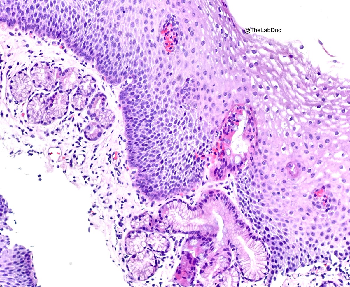 Adult female with reflux symptoms. GE junction biopsy. Cancer or nah? #PathTwitter #PathResidents