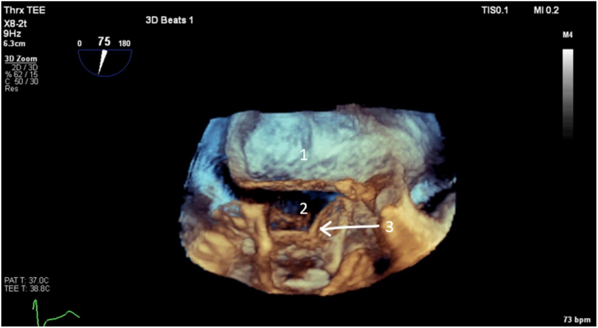 Left atrial dissection is characterized by the formation of a false blood-filled cavity through the mitral annular area into the LA wall, with or without communication into the true left atrium. Read our CASE report, 'LA Dissection Resulting in Asystole.' bit.ly/3V3AcWI