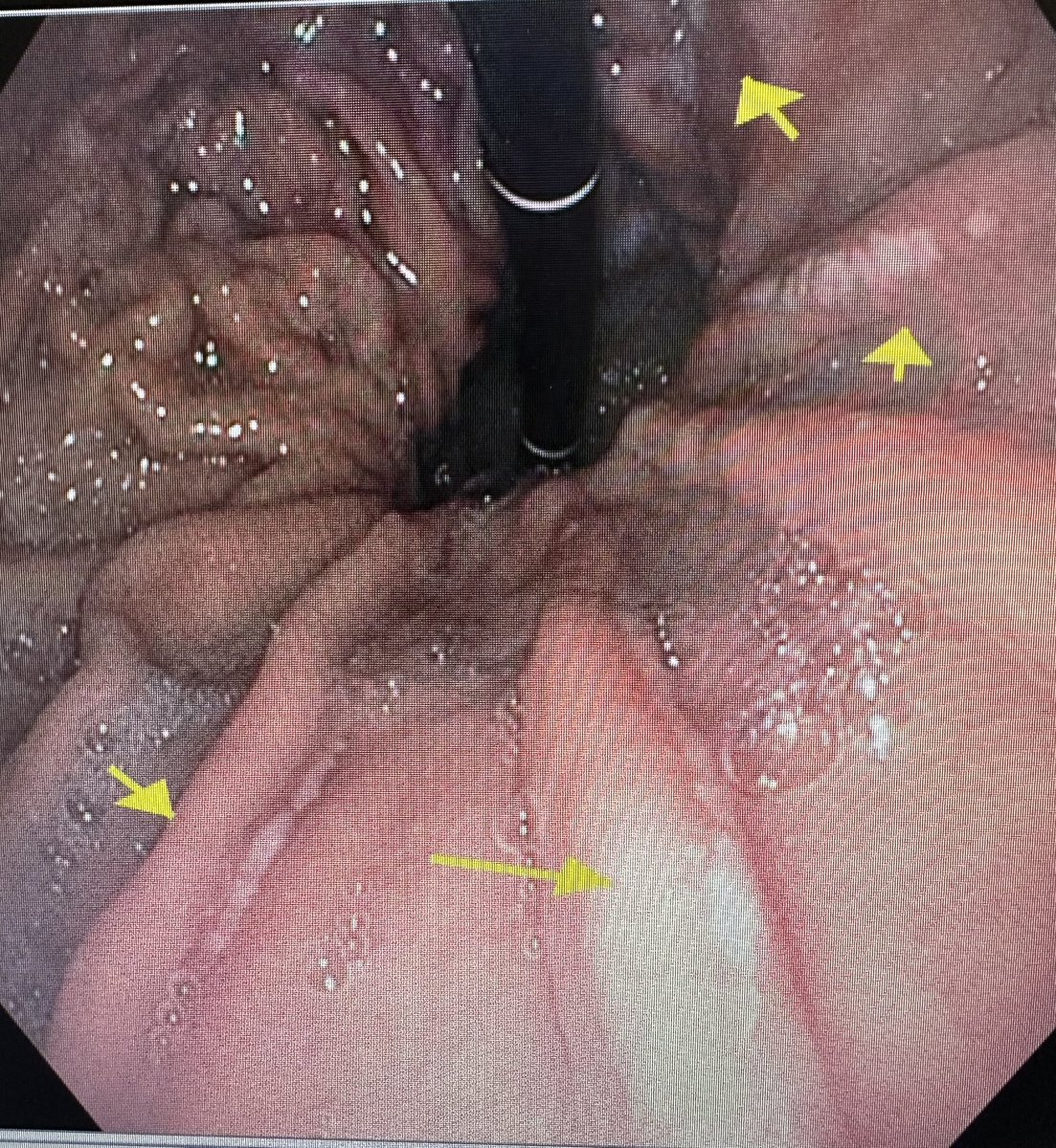 '🔍👀 Discovering Cameron lesions in patients with large hiatal hernias is like finding hidden treasure on a gastric map! These linear erosions at the diaphragmatic pinch tell a tale of the stomach's journey. #CameronLesions #HiatalHernia #MedEd 🗺️'
