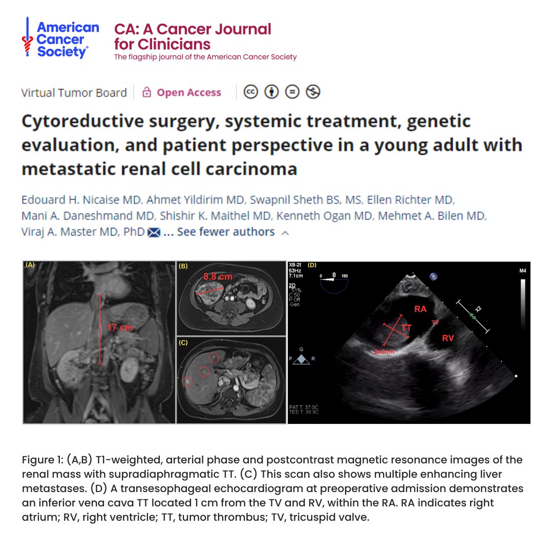 Experts from @WinshipAtEmory treat a young adult w/ metastatic #RenalCellCarcinoma and discuss cytoreductive surgery, systemic treatment, and genetic evaluation in this #VirtualTumorBoard case. The patient perspective is also included. #TumorBoardTuesday acsjournals.onlinelibrary.wiley.com/doi/10.3322/ca…