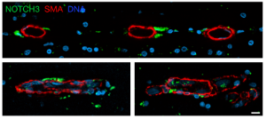 Now online in @CD_AACR: Perivascular NOTCH3+ Stem Cells Drive #Meningioma Tumorigenesis and Resistance to Radiotherapy - by @abrarc, Martha Cady, @LabRaleigh, and colleagues doi.org/10.1158/2159-8… @UCSF