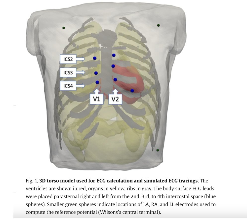 Insights from a whole-heart 🫀and torso computer model of competing hypotheses of Brugada syndrome 👉further support for the depolarization hypothesis! 🔖 bit.ly/44GvAc0 @ELS_Cardiology #CardioTwitter @DrJohSteinfurt @HenrikeHillmann @BetzKonstanze @Dominik_Linz