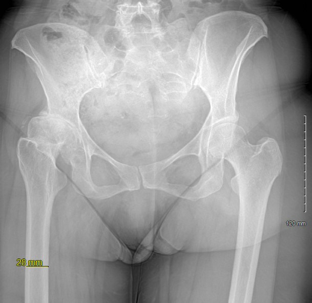 A novel technique using open-access software for preoperative total #hip arthroplasty templating for patients with significantly abnormal hip anatomy due to unilateral hip arthrosis journals.healio.com/doi/10.3928/01… #orthopedics #orthopaedics