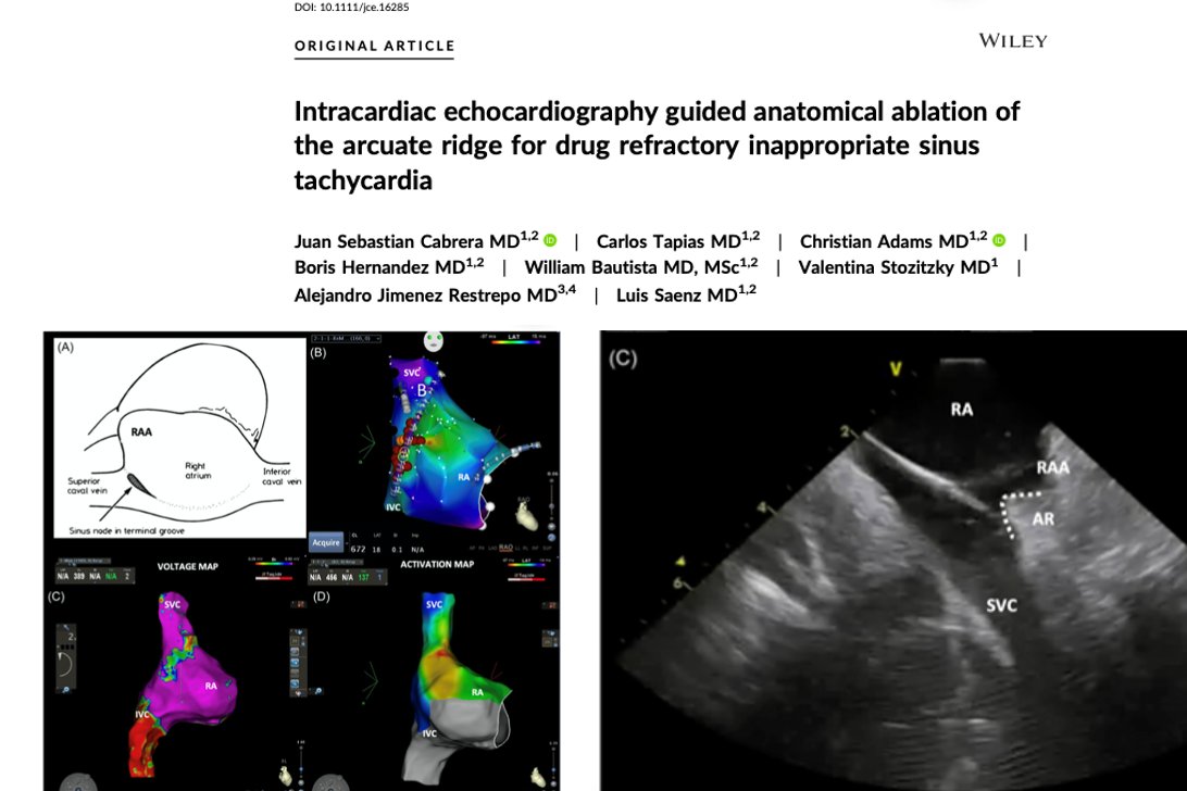 We share our latest paper “Intracardiac echocardiography guided anatomical ablation of the arcuate ridge for drug refractory inappropriate sinus tachycardia” published in @JCardioep doi.org/10.1111/jce.16… @ERES_CABRERA @drluissaenz @AdamsCardioMD @DrAJRestrepo @Boris_Migue