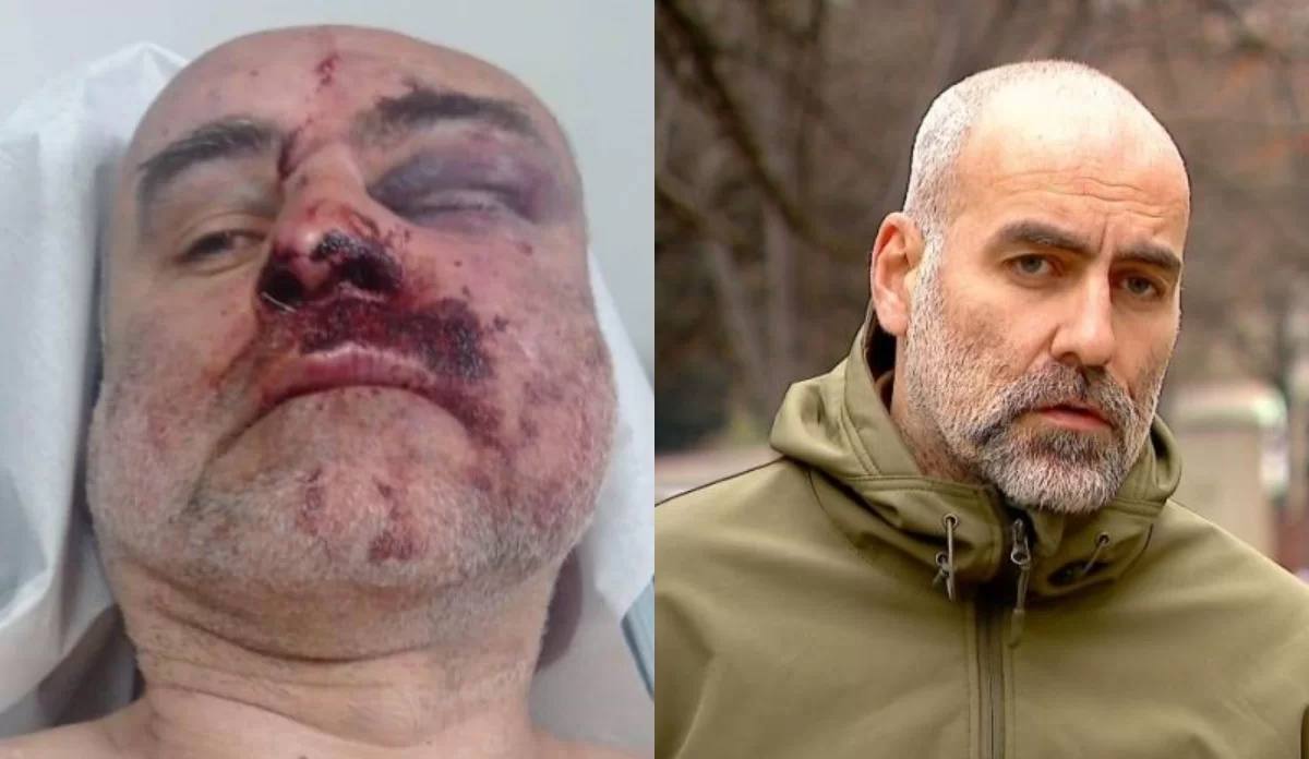 ❗️ David Katsarava, leader of the Anti-Occupation Movement, was severely beaten while being detained at a rally against the law 'on foreign agents' in #Tbilisi. Katsarava is currently in hospital. The photo shows that he received serious head injuries.