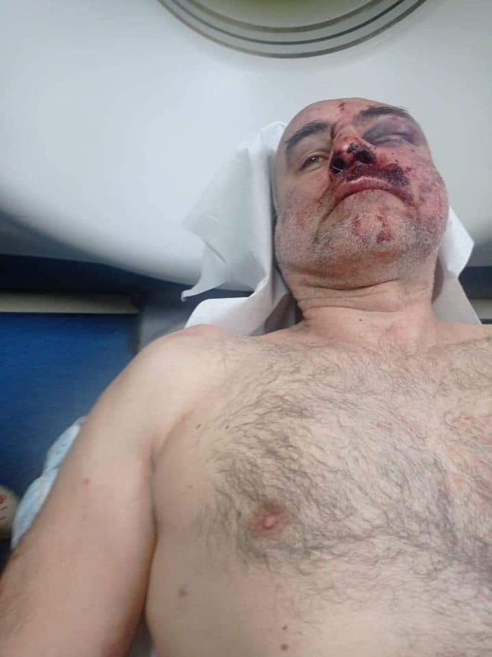 ❗️ Davit Katsarava, the leader of the anti-occupation movement, was severely beaten by the police after his arrest. Katsarava is currently hospitalized
#Georgia #NoToRussianLaw