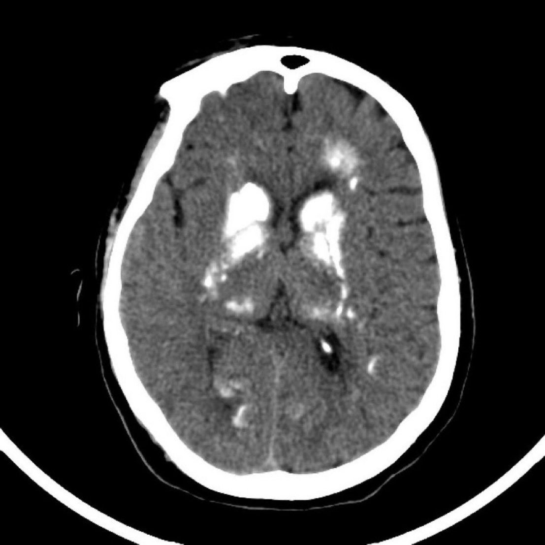 A 45 year old man presented with chronic headache and memory problems. Workup was largely unremarkable. A CT scan was done. What is the likely diagnosis? (Image @Radiopaedia, case by Ahmed Faaz Nasser) #Neurology