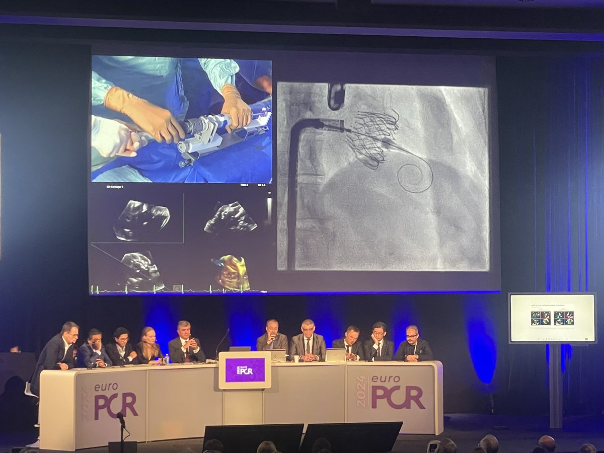 Excellent live case and demonstration of #EVOQUE Tricuspid Valve Replacement from Mainz, Germany #EuroPCR2024 #EuroPCR @PCRonline @ANazmiCalik @aayshacader @valeriaparadies @Sticchi_Alex