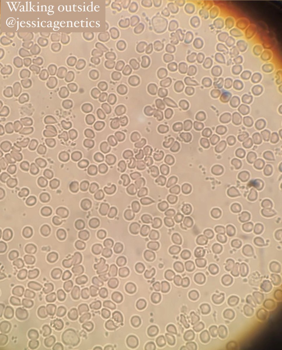 Red blood cells after a walk on the treadmill indoors surrounded by nnEMF + artificial light vs After a walk outside in fresh air & in the sun Moral: get outside! 🍃☀️