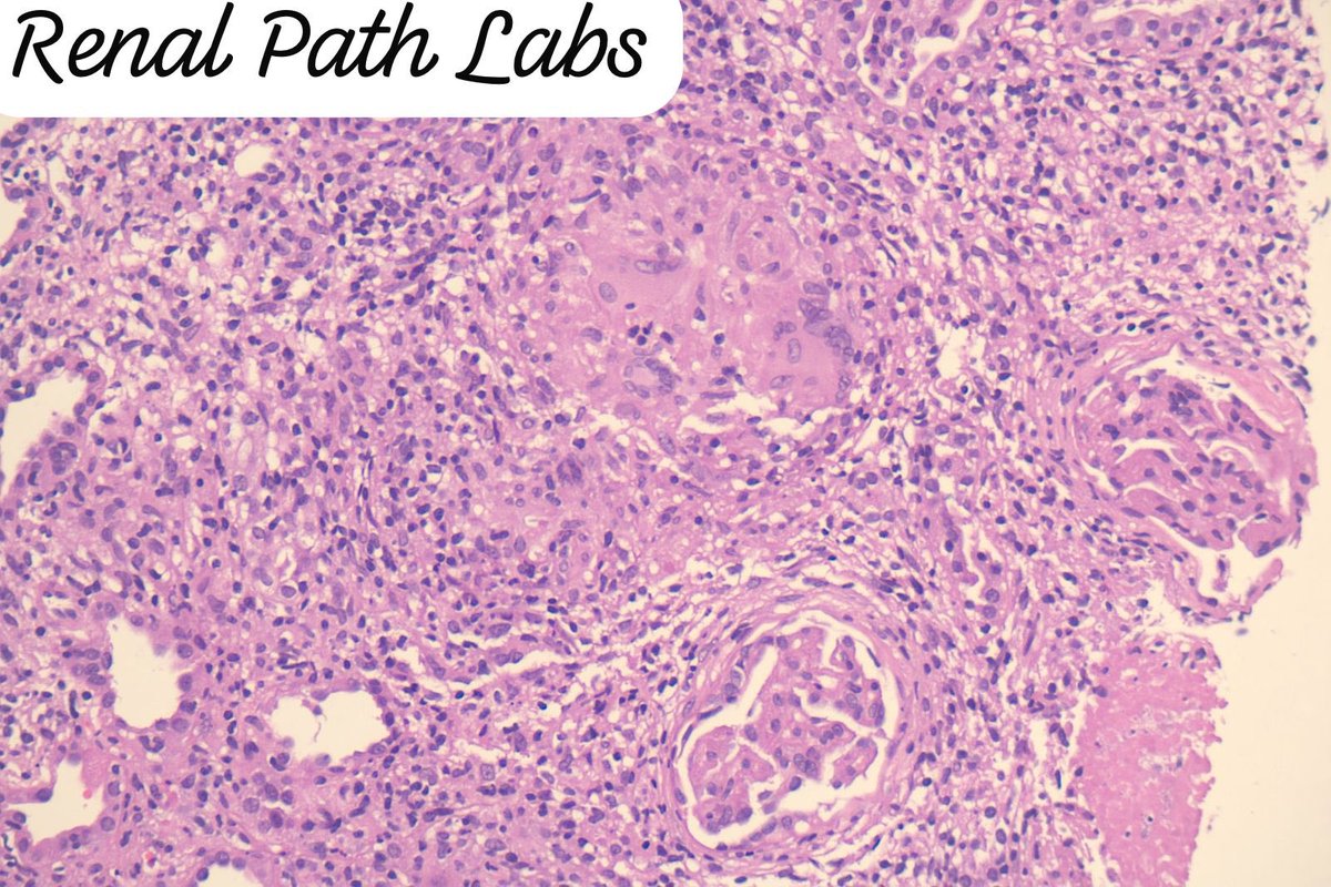 Another Tx. Another story. Identify and give D/D. Books say that sometimes infections can be there wth rejection.. whats your experience?? How often? Management will be tricky then! #RenalPath #TxPathology #AskRenal #AskRenalPath #RenalPathLabs #PoojaMaheshwari #PathTwitter