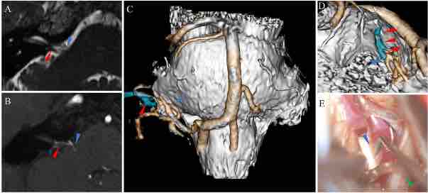 #JNSCaseLessons: A patient series illustrating the utilization of three-dimensional fusion images with high-resolution computed tomography angiography for preoperative evaluation of microvascular decompression
thejns.org/caselessons/co…