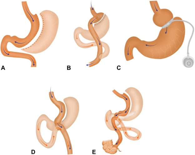 In @GIE_Journal, @SighPichamol offers 'Top tips on endoscopy in post–bariatric surgery patients' here: hubs.ly/Q02wQD1x0. #GITwitter #GIE #GIEJournal