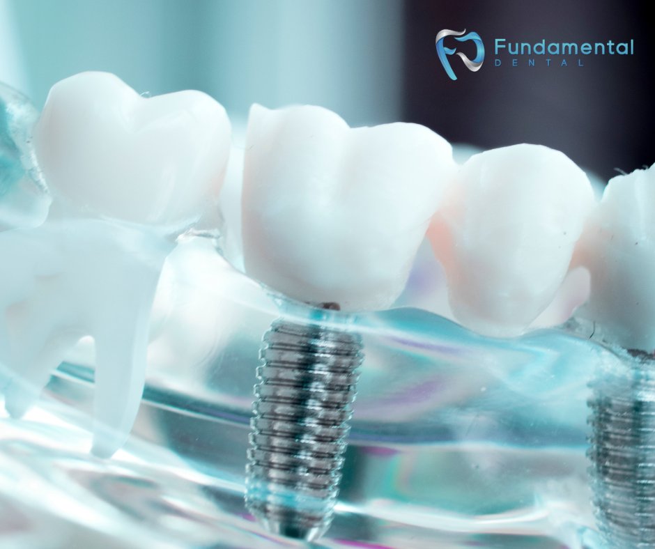 If you think you might want dental implants, call our office to set up an appointment! We'll talk you through the process and answer any questions you may have! 

#FundamentalDental #FunDental #Dentist #Dental #DentistOffice #DentalTreatments #OralHygiene #RootCanals #DallasTX