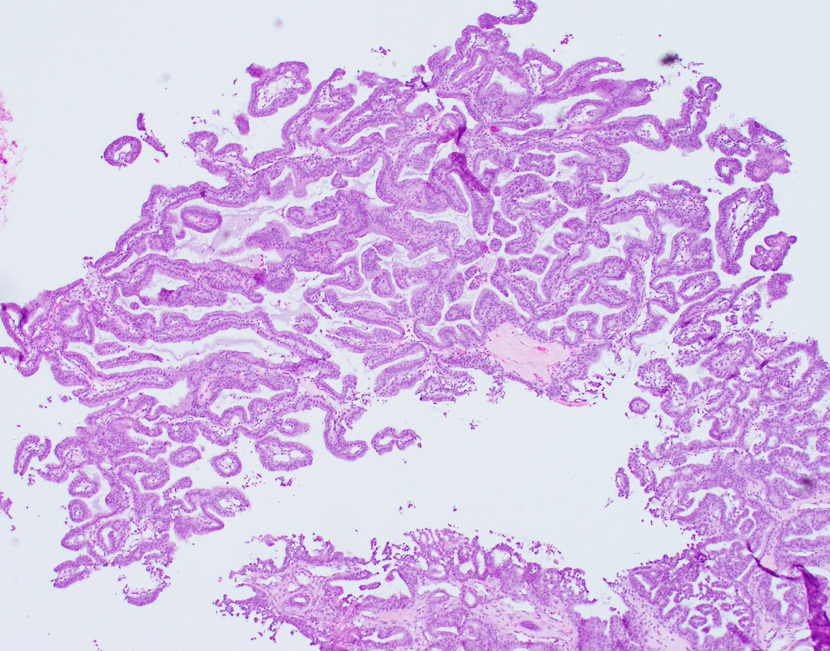 What is your diagnosis on this H&E?

Now look at the IHC in the comment below. What is your diagnosis now?

#breastpath #PathTwitter @washupathedu @wusm_pathology