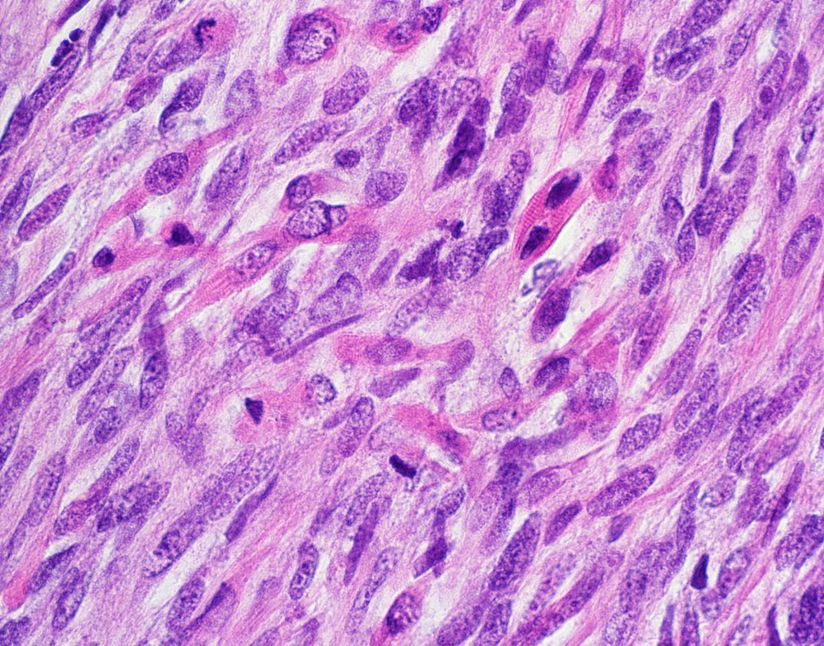 Deep mass in NF1 patient. Diagnosis? 
More pics  kikoxp.com/posts/17897
Answer ✅ youtube.com/watch?v=LBgsIa…
Another example: kikoxp.com/posts/16855
#BSTpath #pathologists #pathology #pathTwitter