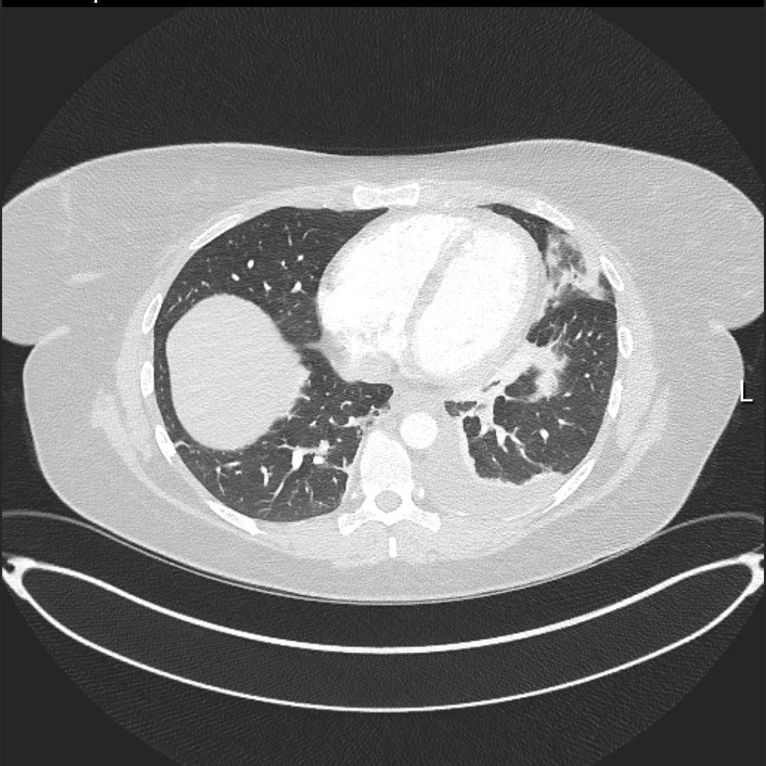 Am in the UK for a family holiday, and after 4 days of sharp left sided chest pain, I decided some medical tourism was in order. Fortunately no PE but a lovely chest infection and pleural effusion! Can't rate the care I had highly enough. Also, my first ever chest xray and CT!
